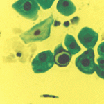 Διάμεσα κύτταρα με διογκωμένους ανισομεγεθεις πυρήνες